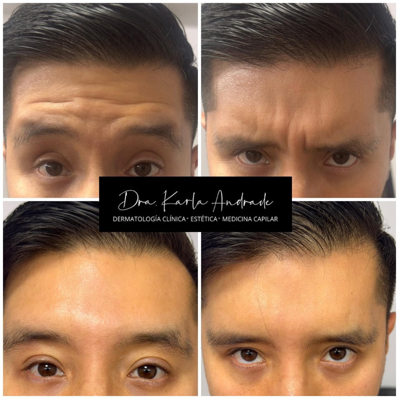 Antes y después de toxina botulínica en paciente masculino tratado por la Dra. Karla Andrade en Machala.